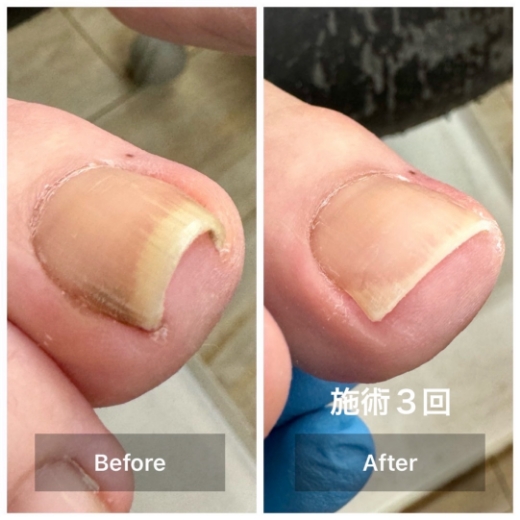 施術後