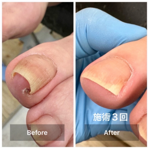 施術後